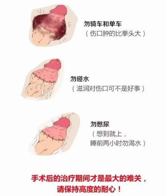 割包皮是什么意思