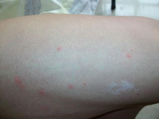 皮炎湿疹是什么