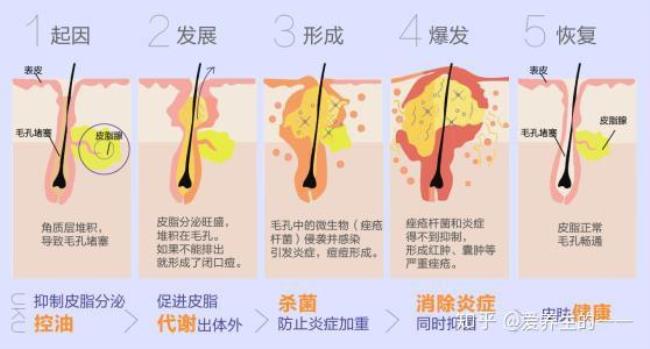 长痘痘的主要原因有哪几个方面