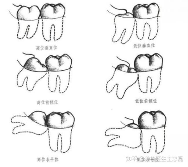 智齿是长在上面还是下面