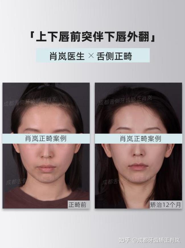 锐角唇是什么样子