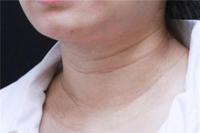 怀孕后脖子上出现颈纹怎么消除