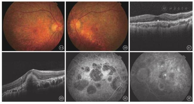 视网膜豹纹状改变怎么回事
