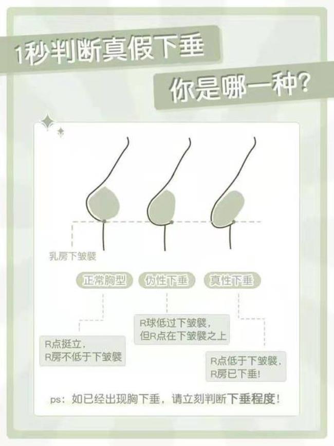 水滴胸和下垂的区别